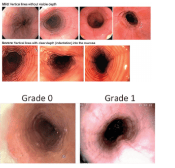 Hình ảnh các rãnh dọc thực quản trên nội soi và phân độ theo thang điểm EREFS (Endoscopic Reference Score): độ 0: không có rãnh dọc, độ 1: có rãnh dọc thực quản (Nguồn ảnh: researchgate.net)