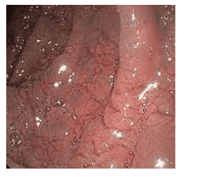 Hình ảnh nội soi tá tràng của bệnh Celiac