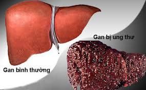 Sau một thời gian nhiễm HCV nếu không được kiểm soát tốt có thể bị ung thư gan