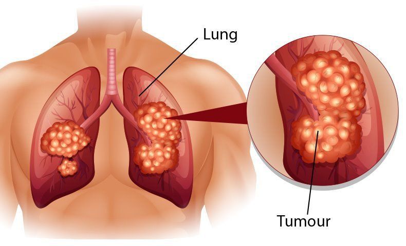 UNG THƯ PHỔI THƯỜNG ĐƯỢC PHÁT HIỆN MUỘN VÀ KHÓ ĐIỀU TRỊ HIỆU QUẢ