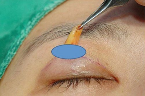 The swelling eyes will a lot within 24 hours and then gradually decrease after removing excess eyelid fat.
