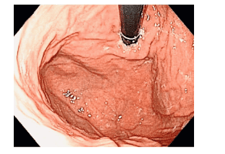 Image 2: Normal appearance of the gastroesophageal fold: the cardia tightly embraces the scope