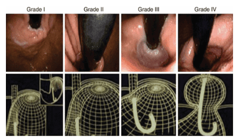 Figure 4: Grading of the GEFV according to the Hill grading system is evaluated as shown in Figure 1. 