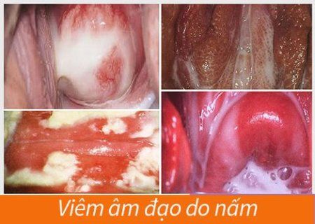 Viêm âm đạo do nấm