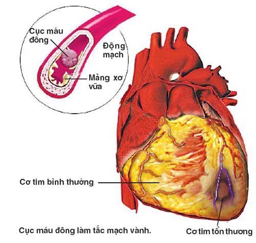 Blood clot formation can cause the loss or reduction of stent effectiveness