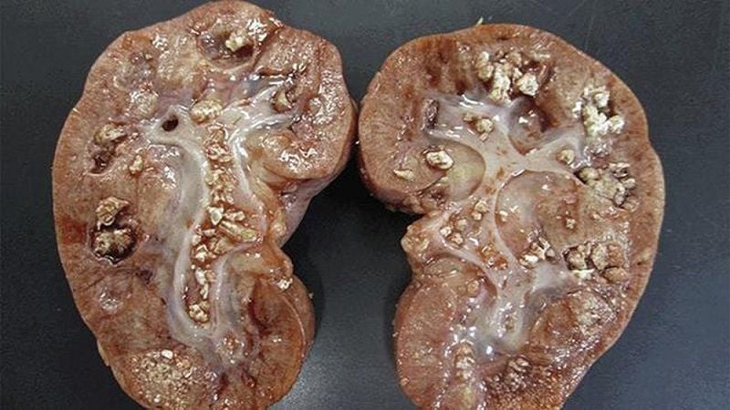 Sự phức tạp của sỏi san hô trong thận | Vinmec