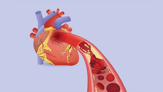 Thiếu máu cơ tim thầm lặng | Vinmec