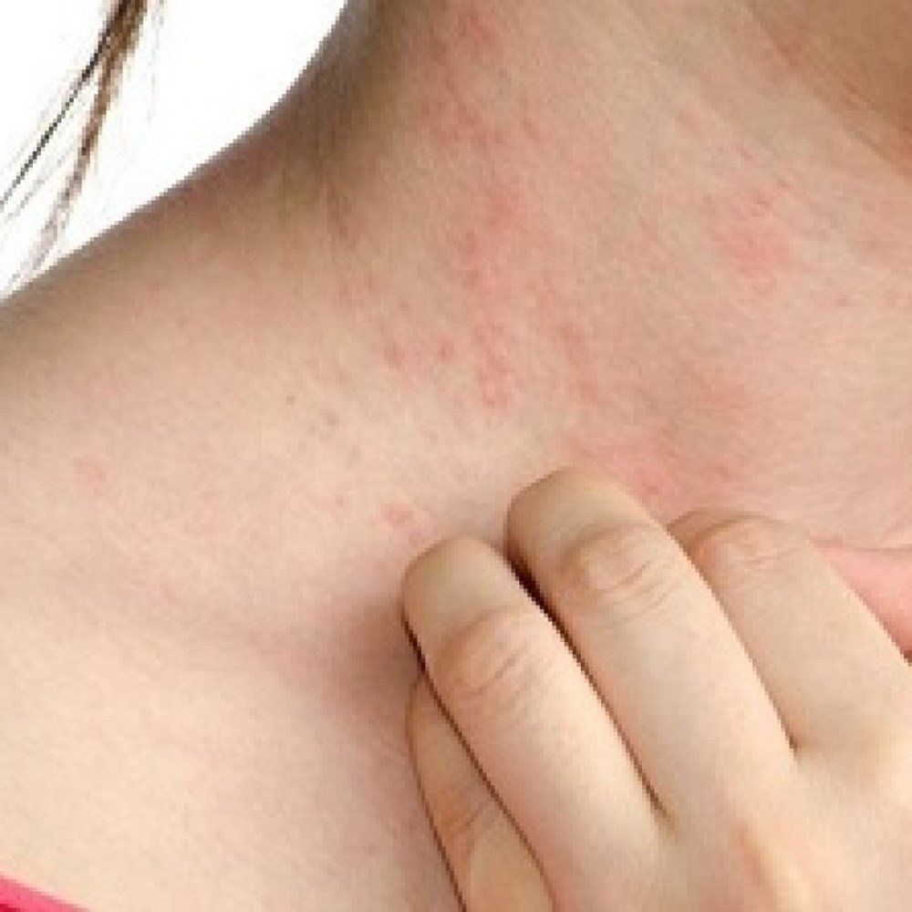 Viêm da dị ứng ngứa và nổi mẩn đỏ phải làm gì? | Vinmec