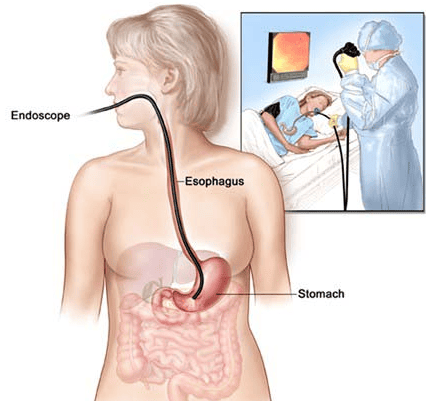 Hiện nay, Nội soi thực quản dạ dày sẽ giúp phát hiện bệnh sớm và có biện pháp xử lý kịp thời bệnh lý trào ngược dạ dày thực quản
