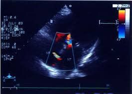 Hình ảnh thông liên thất trên siêu âm Doppler màu