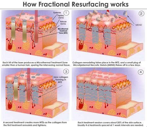 Trẻ hóa da bằng laser fractional CO2