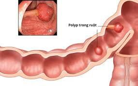 Khó đi ngoài, đi phân ít kèm máu và dịch trắng đục có phải dấu hiệu polyp đại tràng không?