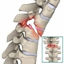 Gãy đốt D12 có nguy hiểm không?