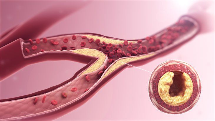 15 loại thực phẩm có thể giúp ngăn ngừa tắc động mạch ...