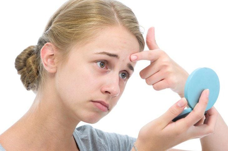 5 cách giúp trẻ dậy thì "sống sót" khi bị mụn | Vinmec