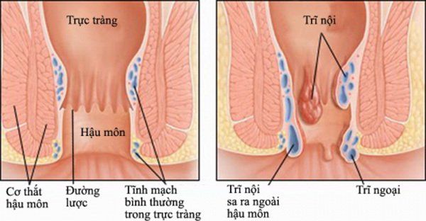 Những dấu hiệu của ung thư trực tràng