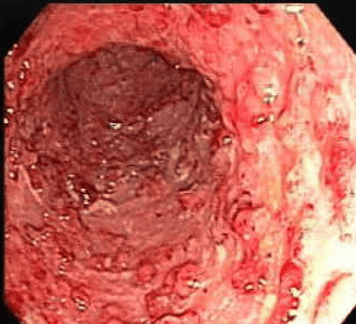 Hình ảnh giả polyp và sẹo loét cũ trong viêm loét đại tràng chảy máu.