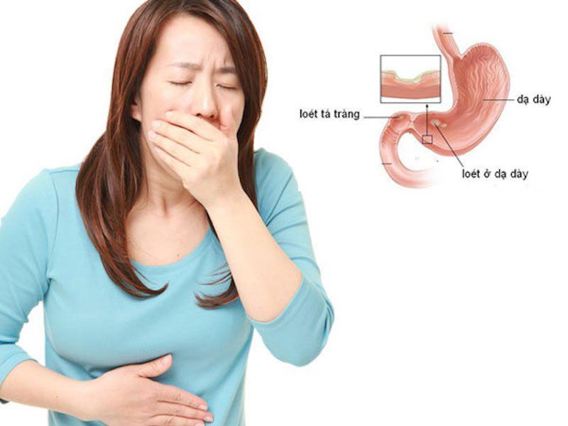 Hay buồn nôn khi đói kèm đau bụng trên là dấu hiệu bệnh gì? | Vinmec