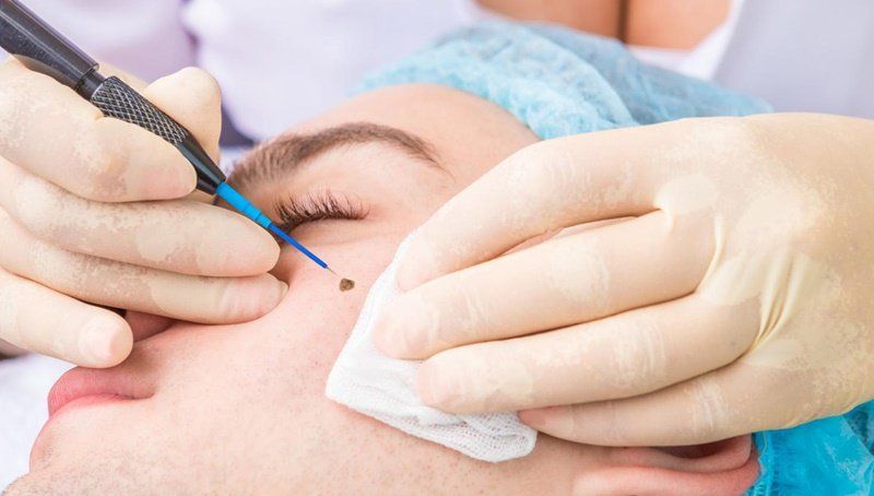 Tẩy Nốt Ruồi Kiêng Thịt Bò Bao Lâu