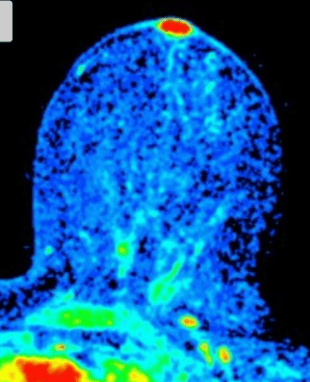 Images of Paget's Disease of the Breast