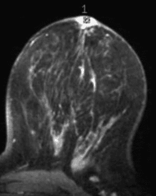 Breast MRI images showing enhancement in the nipple may suggest Paget’s disease.