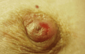 Images of Paget's Disease of the Breast