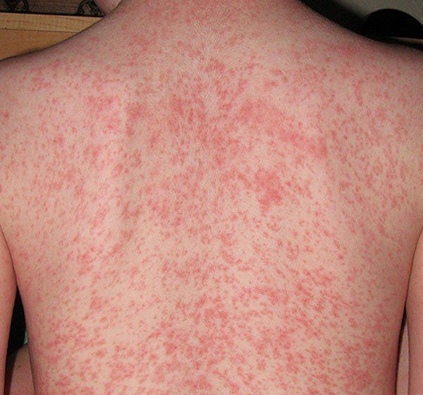 Triệu chứng dị ứng thuốc ARV có thể biểu hiện qua tình trạng phát ban trên da 