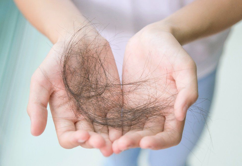 Rụng tóc nội tiết tố androgen là gì? | Vinmec
