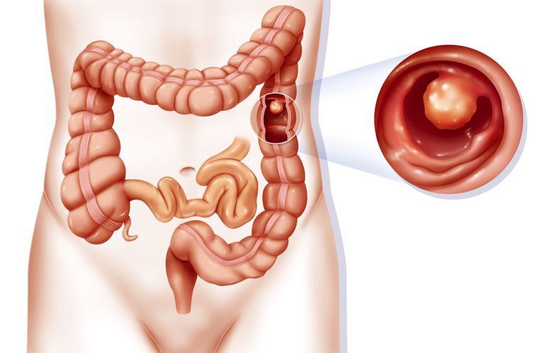 LOẠN SẢN ĐỘ THẤP ĐẠI TRÀNG LÀ DẤU HIỆU CẦN CAN THIỆP NGAY