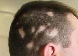 Patchy hair loss or hair that does not grow back may be caused by an immune system attack.
