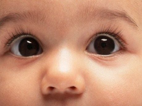 Trẻ 2 tháng tuổi có dấu hiệu bị lác phải làm sao?