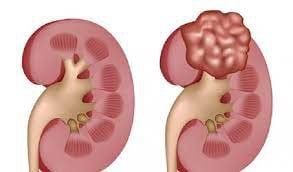Điều trị tử cung phần phụ teo nhỏ, nang thận phải thế nào?