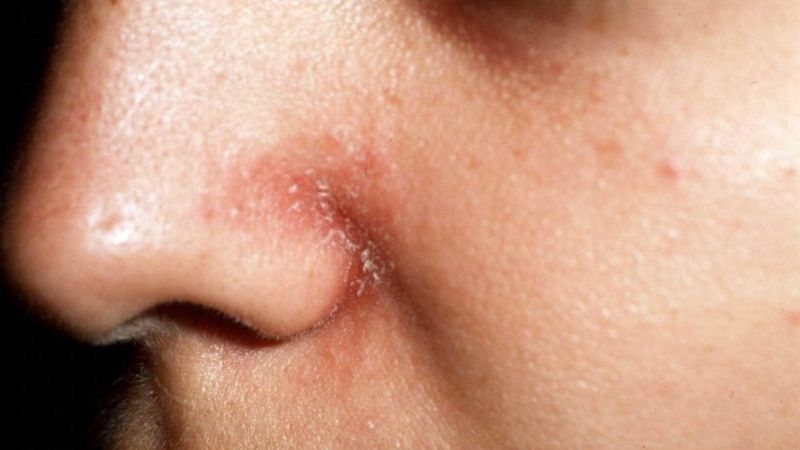 Viêm da tiết bã trên mặt có tự hết không? | Vinmec