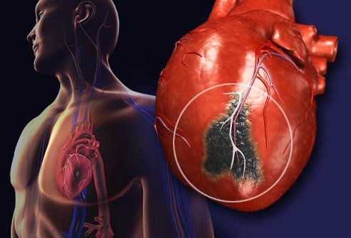 During a heart attack, your heart muscle gets less blood