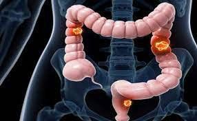 Điều trị bằng metformin ở bệnh nhân ung thư đại trực tràng có thể làm tỷ lệ mắc bệnh giảm