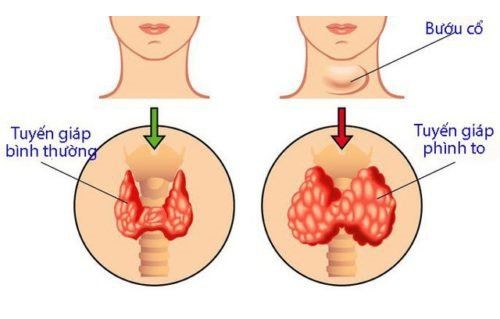 Bệnh lý tuyến giáp ảnh hưởng từ 1 % đến 2 % phụ nữ mang thai