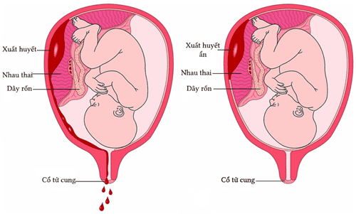 Suy năng tuyến giáp ở người mẹ có thể dẫn đến tình trạng rau bong non
