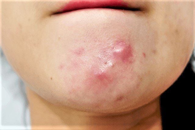 Mọc mụn ở cằm có phải do rối loạn nội tiết? | Vinmec
