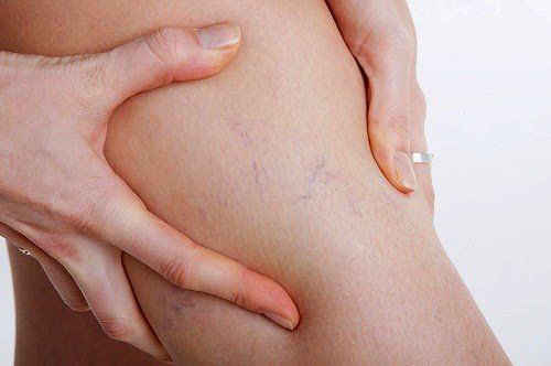 Hai bên đùi có những đường gân nổi lên là bị làm sao?