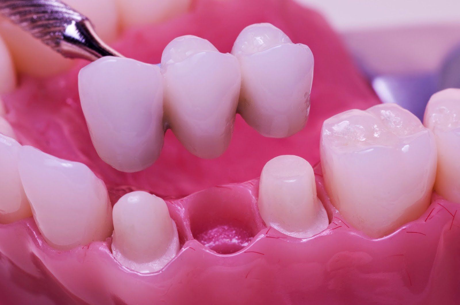 làm cầu răng có tốt không