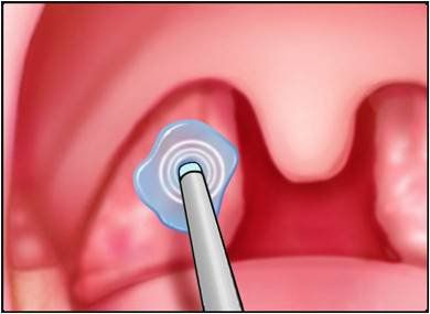 Incision and drainage of peritonsillar abscess