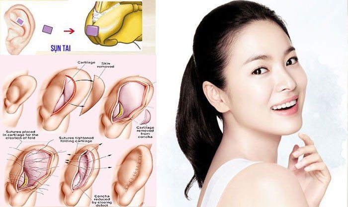 HIỆU QUẢ NÂNG MŨI BỌC SỤN TAI CÓ THỂ DUY TRÌ ĐẾN 20 NĂM TÙY CƠ ĐỊA VÀ CHĂM SÓC