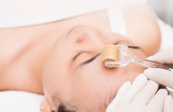 Hiệu quả của điều trị sẹo mụn bằng lăn kim | Vinmec