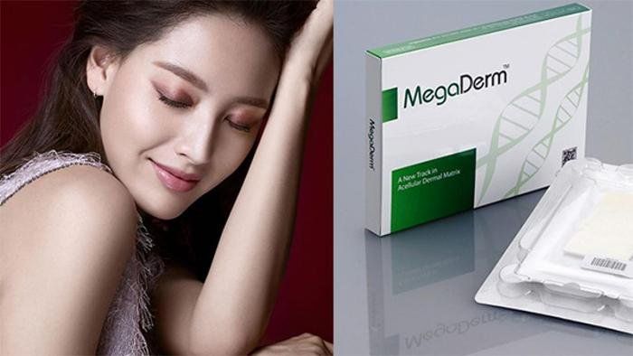 SỤN MEGADERM LÀ TẤM ĐỆM KẸP GIỮA SỤN NHÂN TẠO VÀ DA MŨI