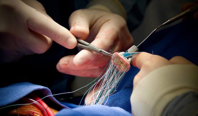 Kỹ thuật thay van tự thân giúp hạn chế tối đa việc sử dụng thuốc kháng đông suốt đời 