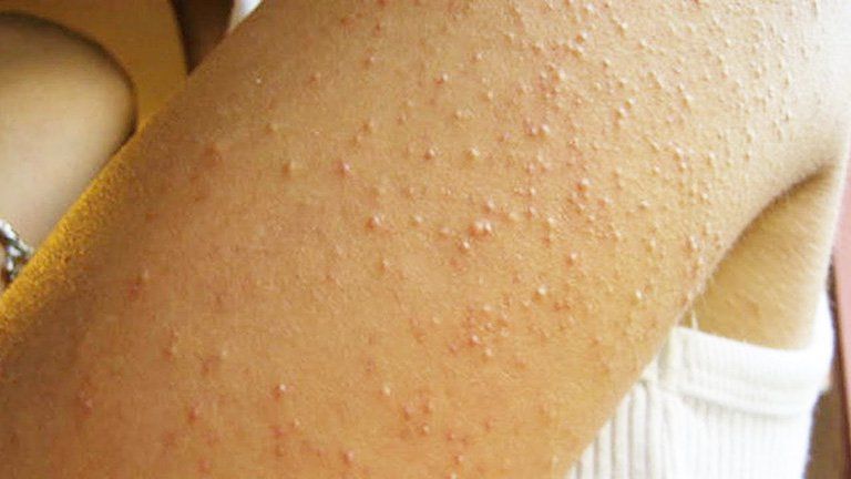 Nguyên nhân và cách điều trị các nốt sần trên da | Vinmec