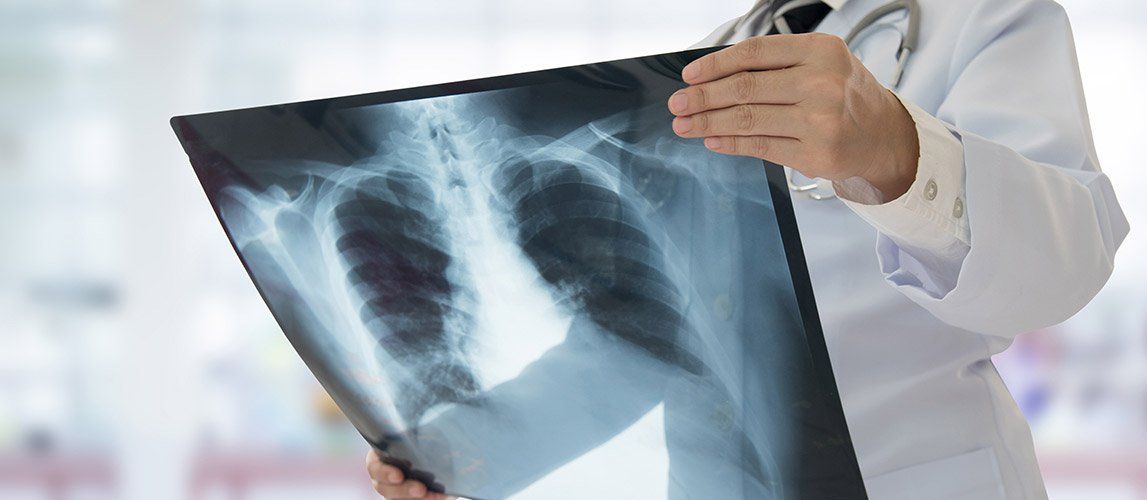 Chẩn đoán hình ảnh đóng vai trò quan trọng trong việc đánh giá mức độ nguy hiểm của aspergilloma