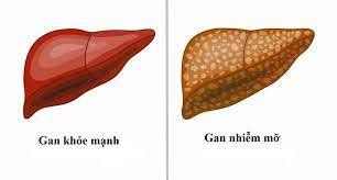 Bệnh gan nhiễm mỡ liên quan đến rối loạn chức năng chuyển hóa