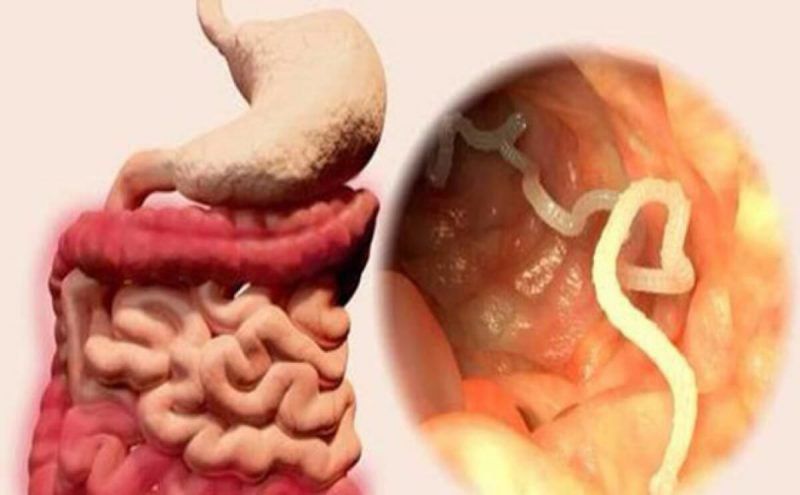 Dấu hiệu nhận biết bị nhiễm giun sán? | Vinmec