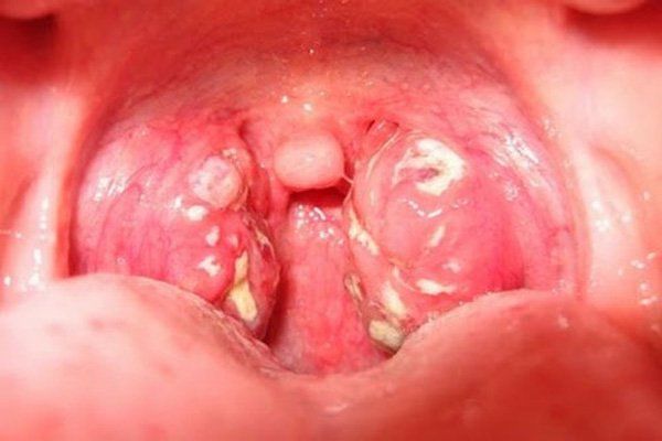 HÌNH ẢNH VIÊM AMIDAN MẠN TÍNH CHO THẤY AMIDAN SƯNG TO VÀ CÓ MỦ BÁM